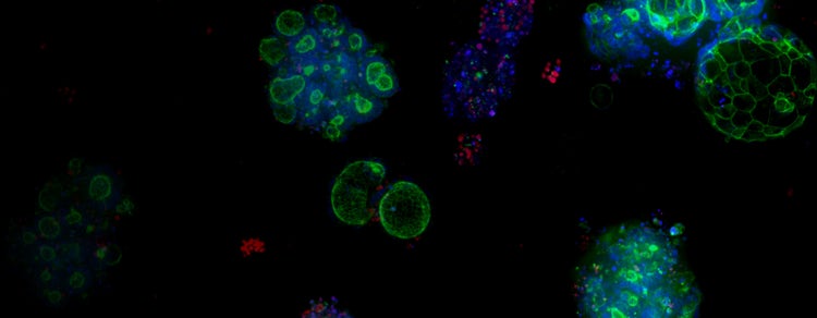 Organoides de cáncer colorrectal (CCR)