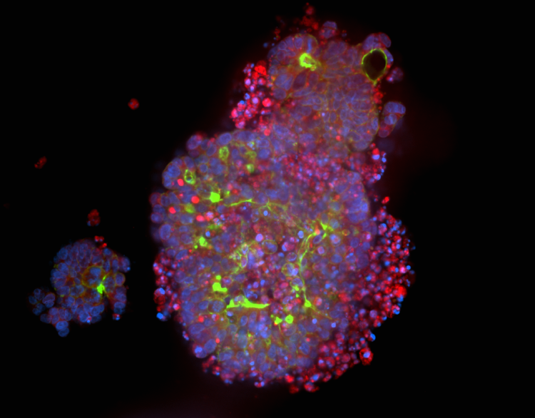 Organoides de cáncer colorrectal derivados de pacientes
