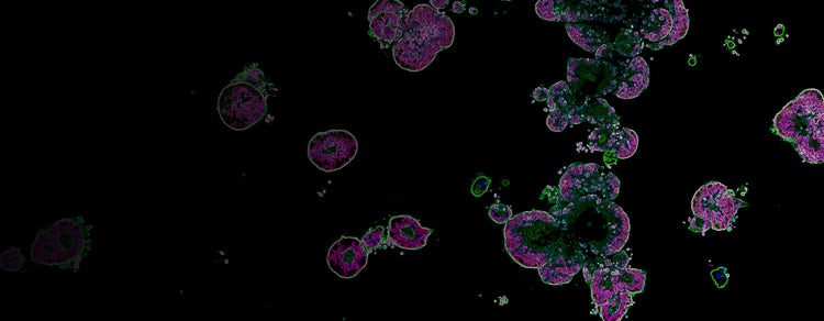 3D colorectal cancer organoids