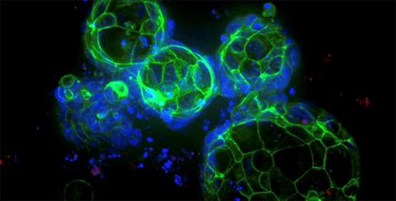 Organoides de cáncer colorrectal