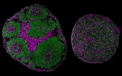 Métodos para la creación de modelos de enfermedades con organoides derivados de pacientes
