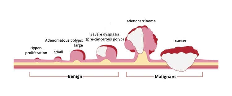 Progresión del cáncer colorrectal (imagen de Guts UK Charity)