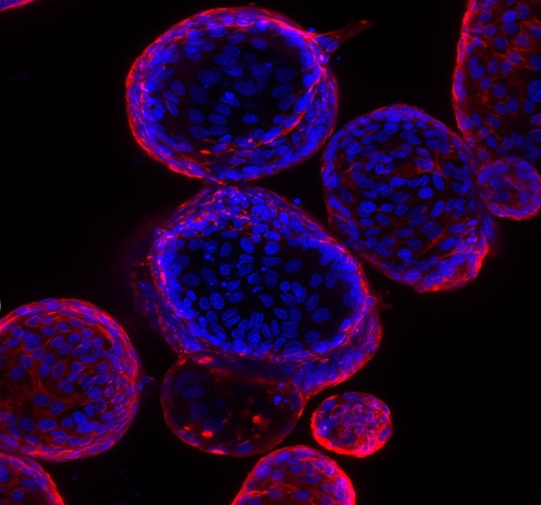 Organoides de adenoma duodenal derivados del tejido de biopsia de un paciente con PAF