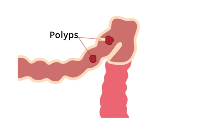 La PAF y la MAP son afecciones hereditarias que pueden provocar la formación de cientos a miles de pólipos colorrectales (imagen de Guts UK Charity)